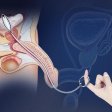 (image for) Oval Bullet Urethral Sound